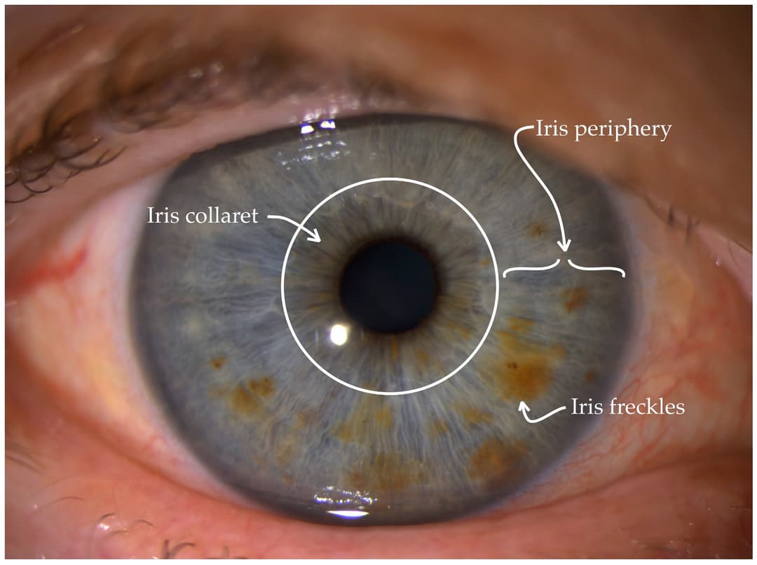 Example image for freckles