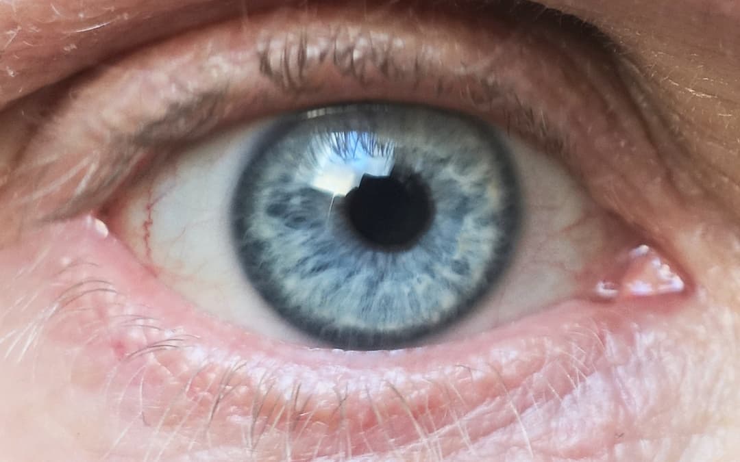 Example image for limbal ring